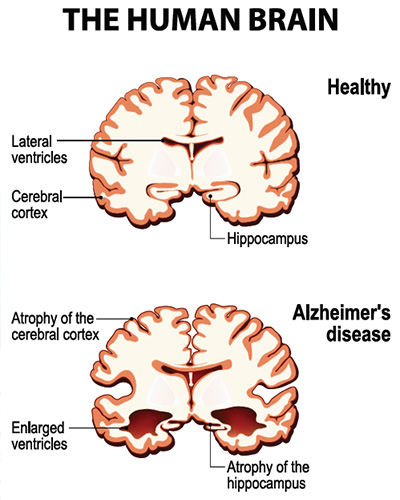 Alzheimers The Human Brain