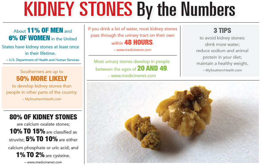 Kidney Stones by the Numbers