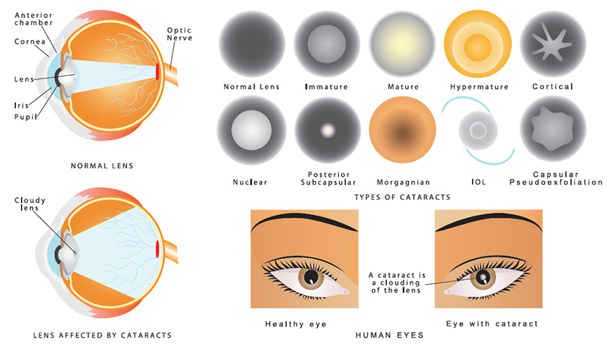 Lens Affected by Cataracts Human Eye