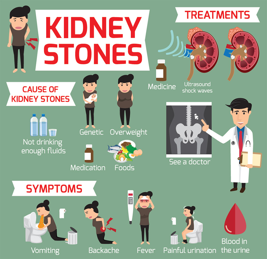 Kidney Stones