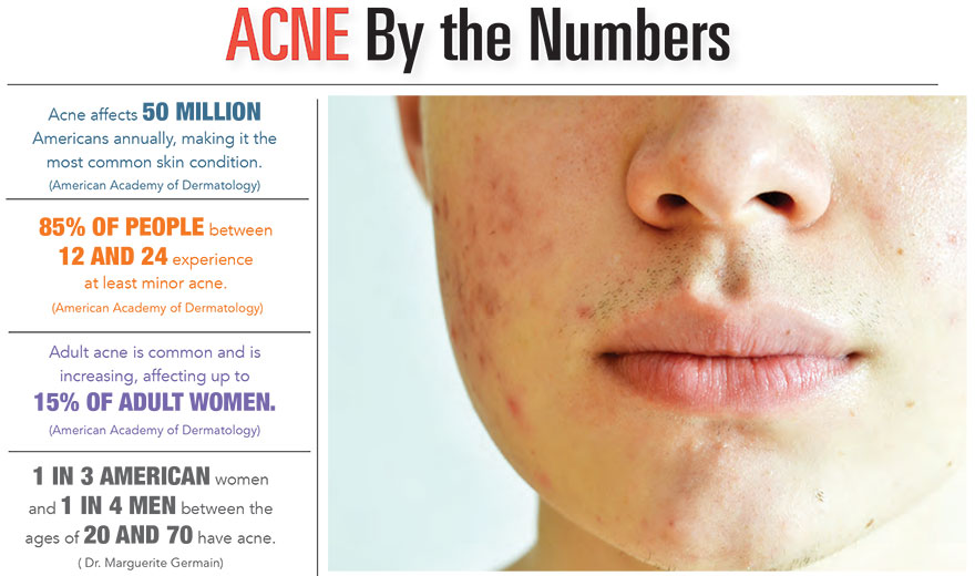 Acne by the Numbers