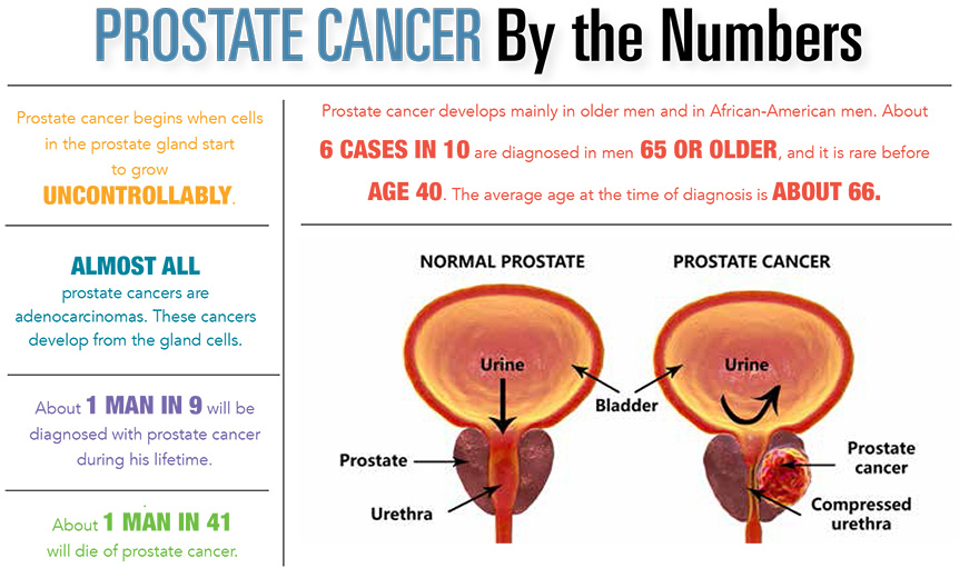 Prostate Cancer by the Numbers