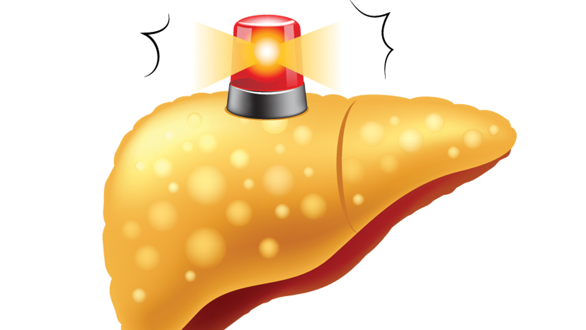 An illustration of a 'liver warning' for article 'NAFLD Has No Symptoms in its Early Stages'