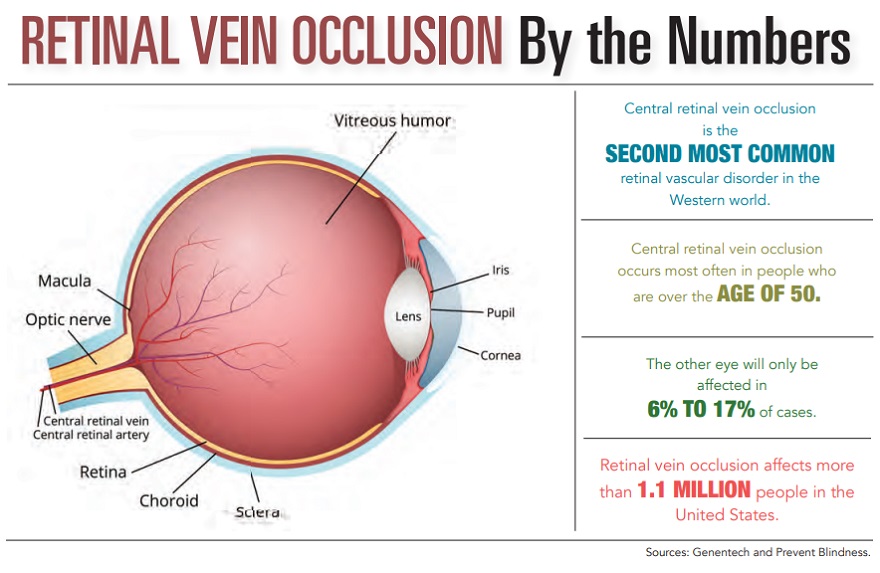 By the Numbers - Retinal Vein Occlusion