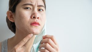 Woman has acne from wearing face mask