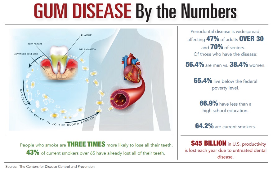 Gum Disease by the Numbers