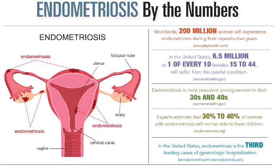 Endometriosis by the Numbers