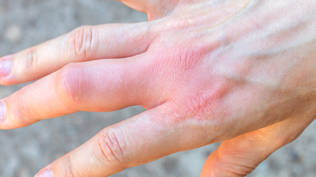 Person with inflammation in hand